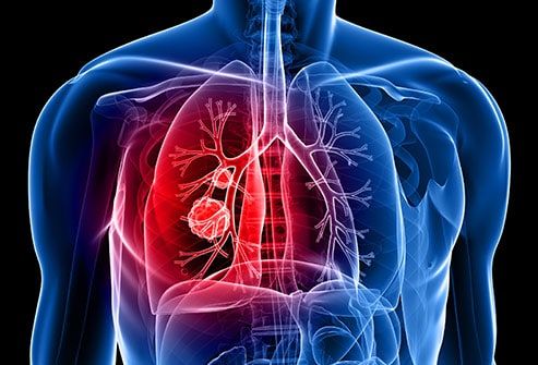 Asbestos can cause lung cancer.
